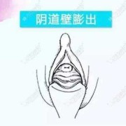 会阴部突然坠胀是怎么回事,孕期阴壁膨出什么原因引起的