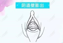 会阴部突然坠胀是怎么回事,孕期阴壁膨出什么原因引起的