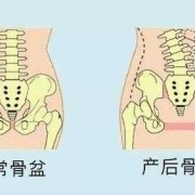 剖腹产需要做盆骨修复吗,孕期骨盆变化图片