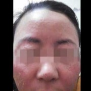 胎儿汞中毒（胎儿汞中毒）