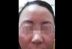 胎儿汞中毒（胎儿汞中毒）