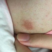 怀孕后乳头总是发痒，这是怎么回事呢,怀孕期间乳头痒怎么回事啊