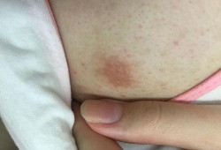 怀孕后乳头总是发痒，这是怎么回事呢,怀孕期间乳头痒怎么回事啊
