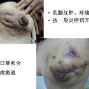 孕期乳腺炎（孕期乳腺炎）