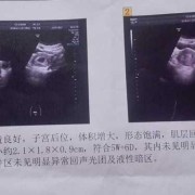 什么是孕囊？孕囊的作用是什么,胎儿胚囊大小对照表
