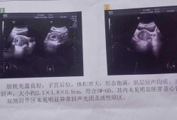 什么是孕囊？孕囊的作用是什么,胎儿胚囊大小对照表