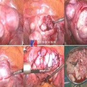 怀孕了宫腔粘连怎么办，不知道是重度还是轻度,孕期宫腔黏连带对胎儿有影响吗