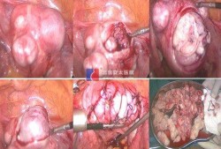 怀孕了宫腔粘连怎么办，不知道是重度还是轻度,孕期宫腔黏连带对胎儿有影响吗