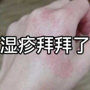 孕期湿疹最佳治疗方法（孕妇得了湿疹用什么药？孕妇身上长湿疹会对胎儿有影响吗）