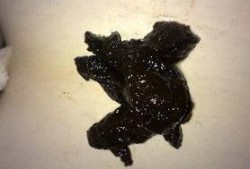孕期便秘头晕（头晕恶心，大便黑色，中暑）