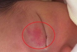婴儿胎记怎么去除,怀孕胎儿胎记怎么引起的