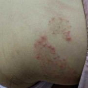 孕期屁股痒（孕期屁股痒是什么原因）