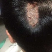 如何避免胎儿长胎记（刚出生的宝宝手背上有黑色胎记怎么消除）
