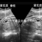 胎儿双肾盂分离知男女（胎儿双肾盂分离男女比例）