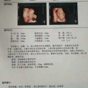 24周胎儿鼻骨正常值是多少,胎儿二十四周发育标准图片