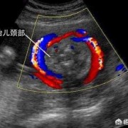 胎儿颈后见u型压迹是什么意思,胎儿脐带u型压迹是什么意思