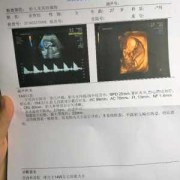 孕14周，胎儿NT厚约0.3cm是什么,怀孕14周胎儿彩超图片