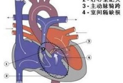 六个月胎儿肺动脉狭窄（什么是先天性肺动脉瓣狭窄）
