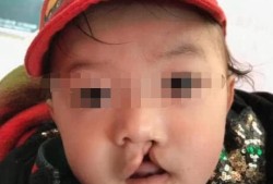 兔唇是怎么回事呢,胎儿为什么会兔唇?
