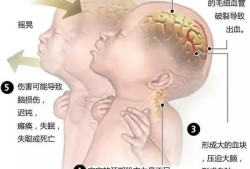 胎儿脑损伤（胎儿脑损伤出生后会出现什么症状）