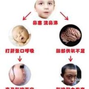 鼻窦炎对胎儿有影响吗（鼻窦炎对胎儿有影响吗）