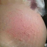 孕期皮肤痒怎么办（孕期皮肤痒怎么办?）