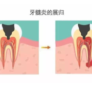 孕期牙周炎（孕期牙痛如何治疗）