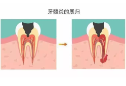 孕期牙周炎（孕期牙痛如何治疗）