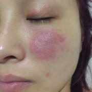 孕期皮肤瘙痒图片（孕妇眼睛痒怎么办）