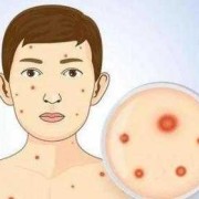 怀孕期间长水痘怎么办（怀孕期间长水痘怎么办啊）