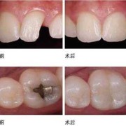 怀孕期间能不能补牙（怀孕期间能不能补牙洞）