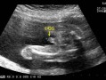 二级产检什么意思,胎儿一级超声检查和二级超声检查区别