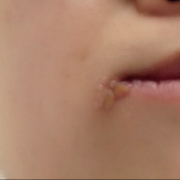 孕妇长疱疹影响胎儿吗（孕中期嘴角长疱疹对胎儿有影响吗）