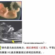 胎儿颈部透明层正常值（我34岁，怀孕12+4，胎儿颈后皮下透明度厚4.5mm请问有什么好的建议）
