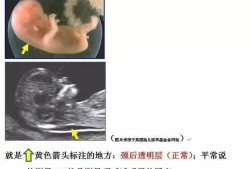 胎儿颈部透明层正常值（我34岁，怀孕12+4，胎儿颈后皮下透明度厚4.5mm请问有什么好的建议）