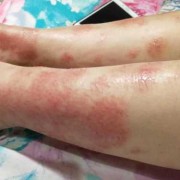孕妇身上发痒是什么原因,孕期全身痒怎么回事儿