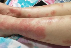孕妇身上发痒是什么原因,孕期全身痒怎么回事儿