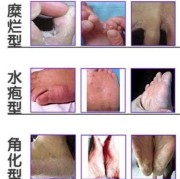孕期足藓（孕期足藓怎么治疗）