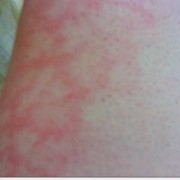 孕期大腿内侧痛（孕期大腿内侧红了一块，又痛是怎么回事）
