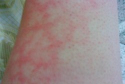 孕期大腿内侧痛（孕期大腿内侧红了一块，又痛是怎么回事）