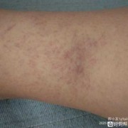 孕期血管疼（孕妇血管疼）