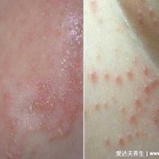 孕期长湿疹是什么原因（孕期长湿疹是什么原因导致的）