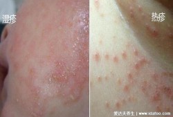 孕期长湿疹是什么原因（孕期长湿疹是什么原因导致的）