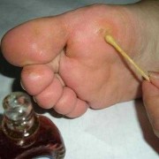 怀孕脚气严重怎么办,孕期脚气严重对胎儿有影响吗