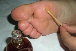 怀孕脚气严重怎么办,孕期脚气严重对胎儿有影响吗
