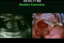 发现胎儿总是在膀胱那里动，是正常的情况吗,孕晚期胎儿膀胱大小正常值