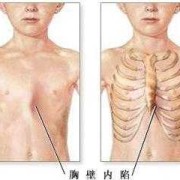 婴儿的肋骨多少根,胎儿少肋骨是畸形吗