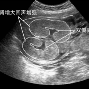 胎儿系统（胎儿左肾集合系统分离是怎么回事）
