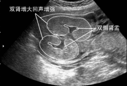 胎儿系统（胎儿左肾集合系统分离是怎么回事）