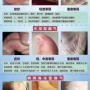怀孕期间有脚气怎么治（怀孕期间有脚气怎么治疗好）